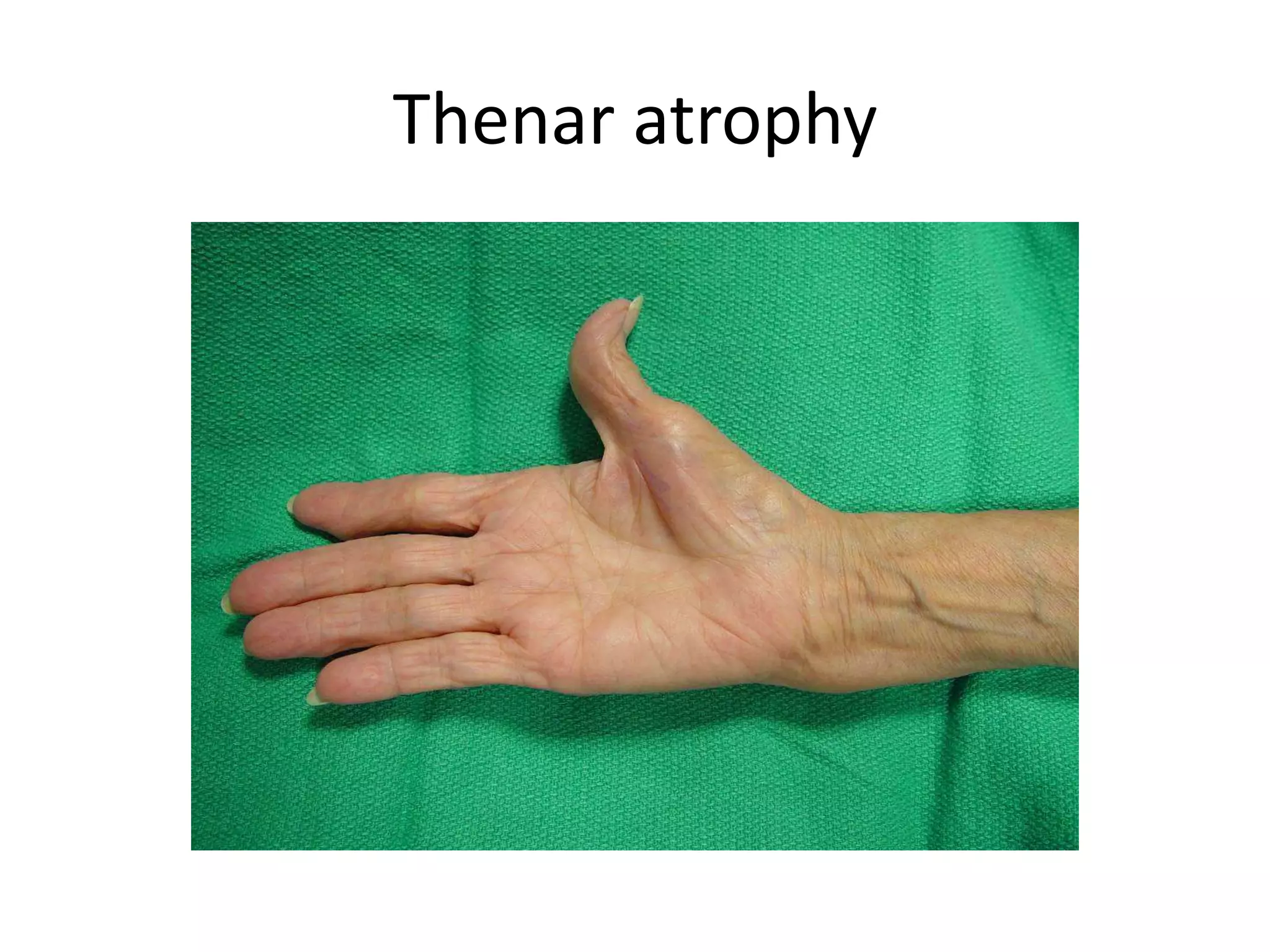 Thenar atrophy
 