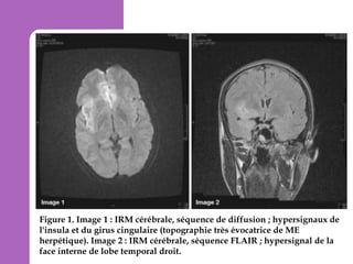Figure 1. Image 1 : IRM cérébrale, séquence de diffusion ; hypersignaux de
l'insula et du girus cingulaire (topographie très évocatrice de ME
herpétique). Image 2 : IRM cérébrale, séquence FLAIR ; hypersignal de la
face interne de lobe temporal droit.

 