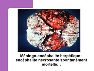 Méningo-encéphalite herpétique :
encéphalite nécrosante spontanément
mortelle…

 