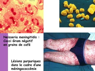Neisseria meningitidis :
Cocci Gram négatif
en grains de café

Lésions purpuriques
dans le cadre d’une
méningococcémie

 