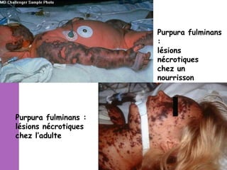 Purpura fulminans
:
lésions
nécrotiques
chez un
nourrisson

Purpura fulminans :
lésions nécrotiques
chez l’adulte

 