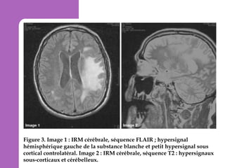 Figure 3. Image 1 : IRM cérébrale, séquence FLAIR ; hypersignal
hémisphérique gauche de la substance blanche et petit hypersignal sous
cortical controlatéral. Image 2 : IRM cérébrale, séquence T2 : hypersignaux
sous-corticaux et cérébelleux.

 