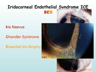 Iridocorneal Endothelial Syndrome ICE
ICE
Iris Naevus
Chandler Syndrome
Essential Iris Atrophy
 
