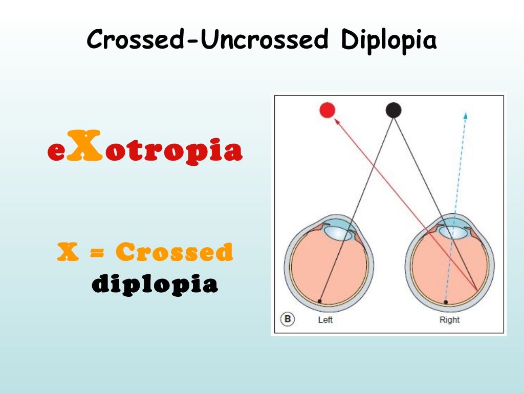 Mnemonics of Ophthalmology II