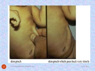 9/15/2014 
17 
www.drjayeshpatidar.blogspot.com  