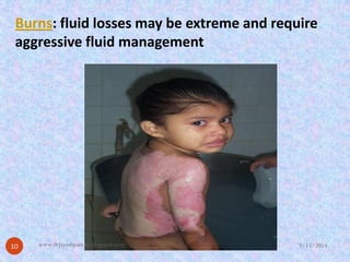 Burns: fluid losses may be extreme and require aggressive fluid management 
9/15/2014 
10 
www.drjayeshpatidar.blogspot.com  