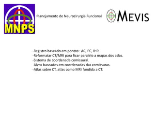 Planejamento de Neurocirurgia Funcional 
-Registro baseado em pontos: AC, PC, IHP. 
-Reformatar CT/MRI para ficar paralelo a mapas dos atlas. 
-Sistema de coordenada comissural. 
-Alvos baseados em coordenadas das comissuras. 
-Atlas sobre CT, atlas como MRI fundida a CT.  