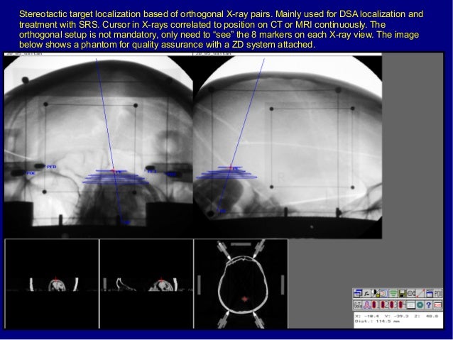 MNPS: Mevis Neurosurgery Planning System. Overview.