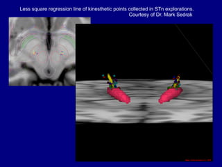 Less square regression line of kinesthetic points collected in STn explorations.
Courtesy of Dr. Mark Sedrak
 