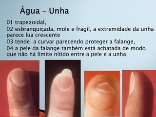 01 trapezoidal,
02 esbranquiçada, mole e frágil, a extremidade da unha
parece lua crescente
03 tende a curvar parecendo proteger a falange,
04 a pele da falange também está achatada de modo
que não há limite nítido entre a pele e a unha
 