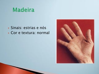    Sinais: estrias e nós
   Cor e textura: normal
 