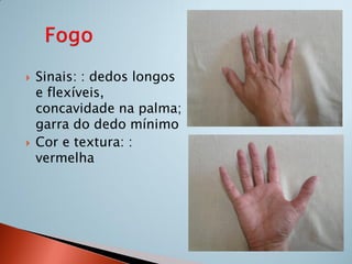    Sinais: : dedos longos
    e flexíveis,
    concavidade na palma;
    garra do dedo mínimo
   Cor e textura: :
    vermelha
 