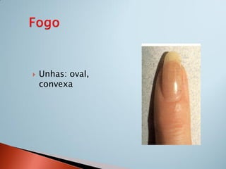    Unhas: oval,
    convexa
 