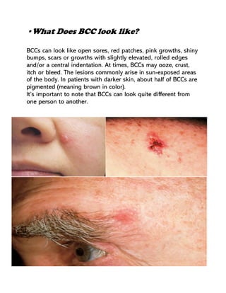 •What Does BCC look like?
BCCs can look like open sores, red patches, pink growths, shiny
bumps, scars or growths with slightly elevated, rolled edges
and/or a central indentation. At times, BCCs may ooze, crust,
itch or bleed. The lesions commonly arise in sun-exposed areas
of the body. In patients with darker skin, about half of BCCs are
pigmented (meaning brown in color).
It’s important to note that BCCs can look quite different from
one person to another.
 