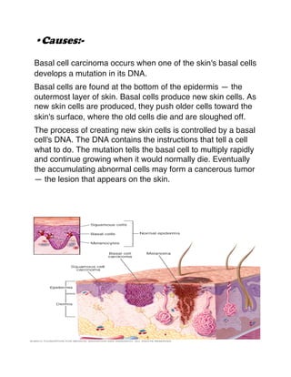 •Causes:-
Basal cell carcinoma occurs when one of the skin's basal cells
develops a mutation in its DNA.
Basal cells are found at the bottom of the epidermis — the
outermost layer of skin. Basal cells produce new skin cells. As
new skin cells are produced, they push older cells toward the
skin's surface, where the old cells die and are sloughed off.
The process of creating new skin cells is controlled by a basal
cell's DNA. The DNA contains the instructions that tell a cell
what to do. The mutation tells the basal cell to multiply rapidly
and continue growing when it would normally die. Eventually
the accumulating abnormal cells may form a cancerous tumor
— the lesion that appears on the skin.
 