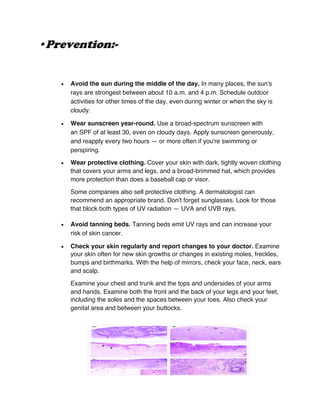 •Prevention:-
• Avoid the sun during the middle of the day. In many places, the sun's
rays are strongest between about 10 a.m. and 4 p.m. Schedule outdoor
activities for other times of the day, even during winter or when the sky is
cloudy.
• Wear sunscreen year-round. Use a broad-spectrum sunscreen with
an SPF of at least 30, even on cloudy days. Apply sunscreen generously,
and reapply every two hours — or more often if you're swimming or
perspiring.
• Wear protective clothing. Cover your skin with dark, tightly woven clothing
that covers your arms and legs, and a broad-brimmed hat, which provides
more protection than does a baseball cap or visor.
Some companies also sell protective clothing. A dermatologist can
recommend an appropriate brand. Don't forget sunglasses. Look for those
that block both types of UV radiation — UVA and UVB rays.
• Avoid tanning beds. Tanning beds emit UV rays and can increase your
risk of skin cancer.
• Check your skin regularly and report changes to your doctor. Examine
your skin often for new skin growths or changes in existing moles, freckles,
bumps and birthmarks. With the help of mirrors, check your face, neck, ears
and scalp.
Examine your chest and trunk and the tops and undersides of your arms
and hands. Examine both the front and the back of your legs and your feet,
including the soles and the spaces between your toes. Also check your
genital area and between your buttocks.
 