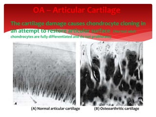 OA – Articular Cartilage
The cartilage damage causes chondrocyte cloning in
an attempt to restore articular surface (Normal adult
chondrocytes are fully differentiated and do not proliferate)
(A) Normal articular cartilage (B) Osteoarthritic cartilage
 