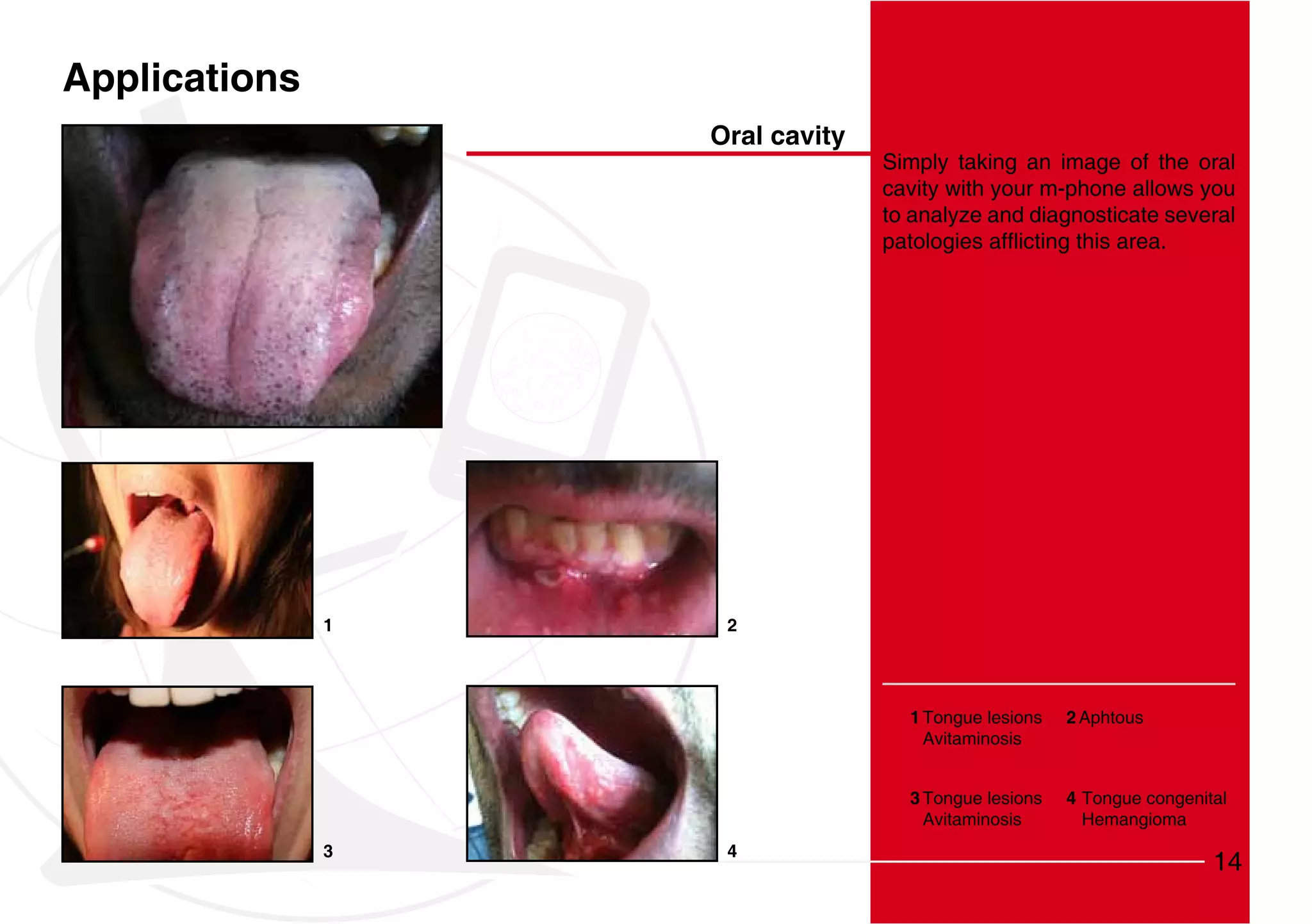 Applications
                   Oral cavity
                                 Simply taking an image of the oral
                                 cavity with your m-phone allows you
                                 to analyze and diagnosticate several




               1    2




                                   1 Tongue lesions   2 Aphtous
                                     Avitaminosis


                                   3 Tongue lesions   4 Tongue congenital
                                     Avitaminosis       Hemangioma
               3    4
                                                                       14
 