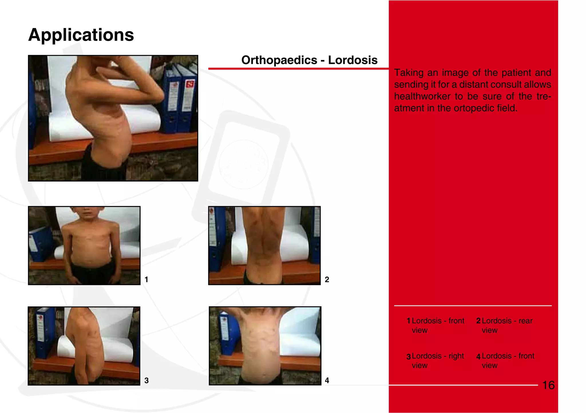 Applications
                   Orthopaedics - Lordosis
                                             Taking an image of the patient and
                                             sending it for a distant consult allows
                                             healthworker to be sure of the tre-




               1                 2




                                                1 Lordosis - front   2 Lordosis - rear
                                                  view                 view


                                                3 Lordosis - right   4 Lordosis - front
                                                  view                 view
               3                 4
                                                                                          16
 