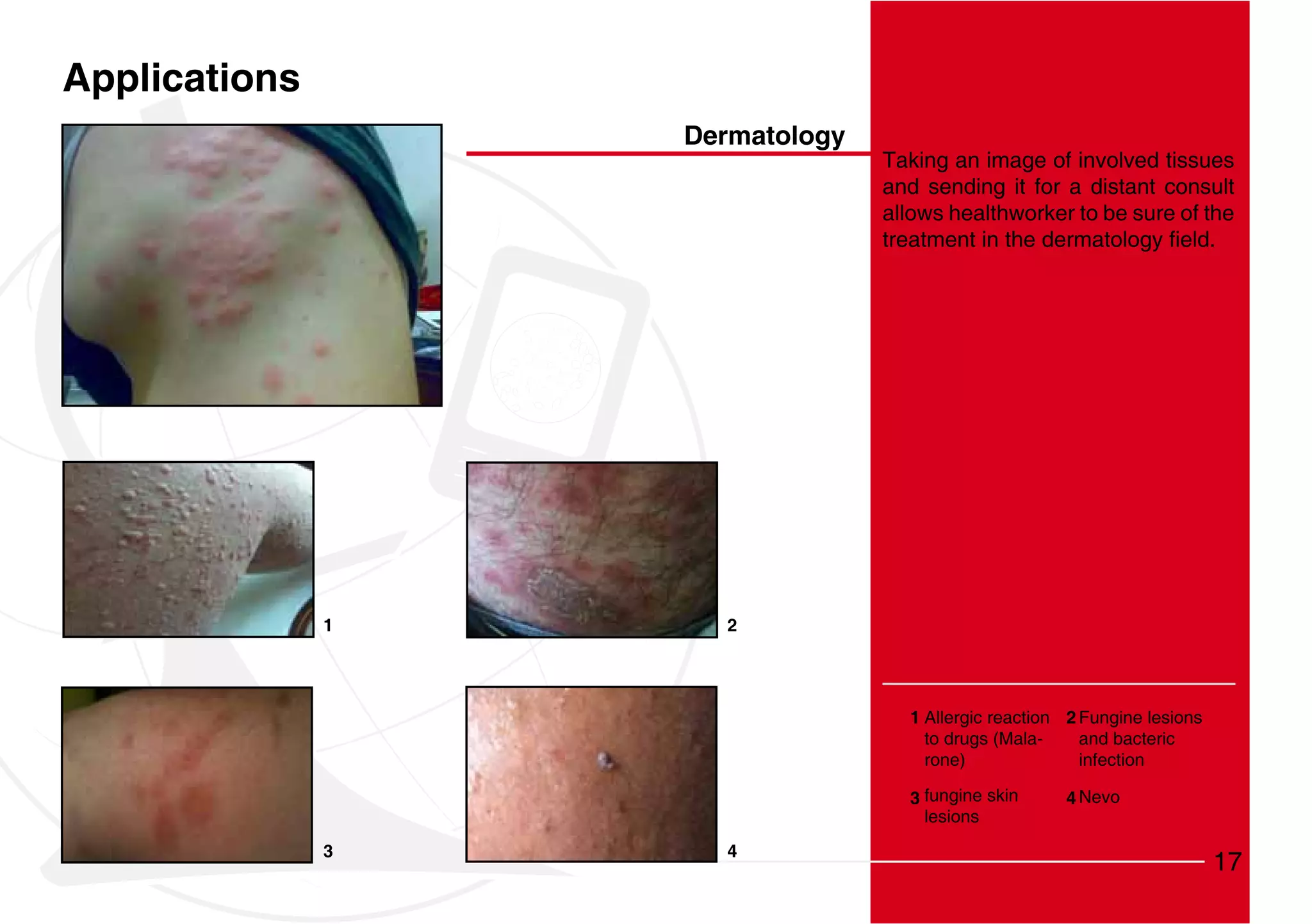 Applications
                   Dermatology
                                 Taking an image of involved tissues
                                 and sending it for a distant consult
                                 allows healthworker to be sure of the




               1     2




                                   1 Allergic reaction 2 Fungine lesions
                                     to drugs (Mala-     and bacteric
                                     rone)               infection

                                   3 fungine skin     4 Nevo
                                     lesions
               3     4
                                                                           17
 
