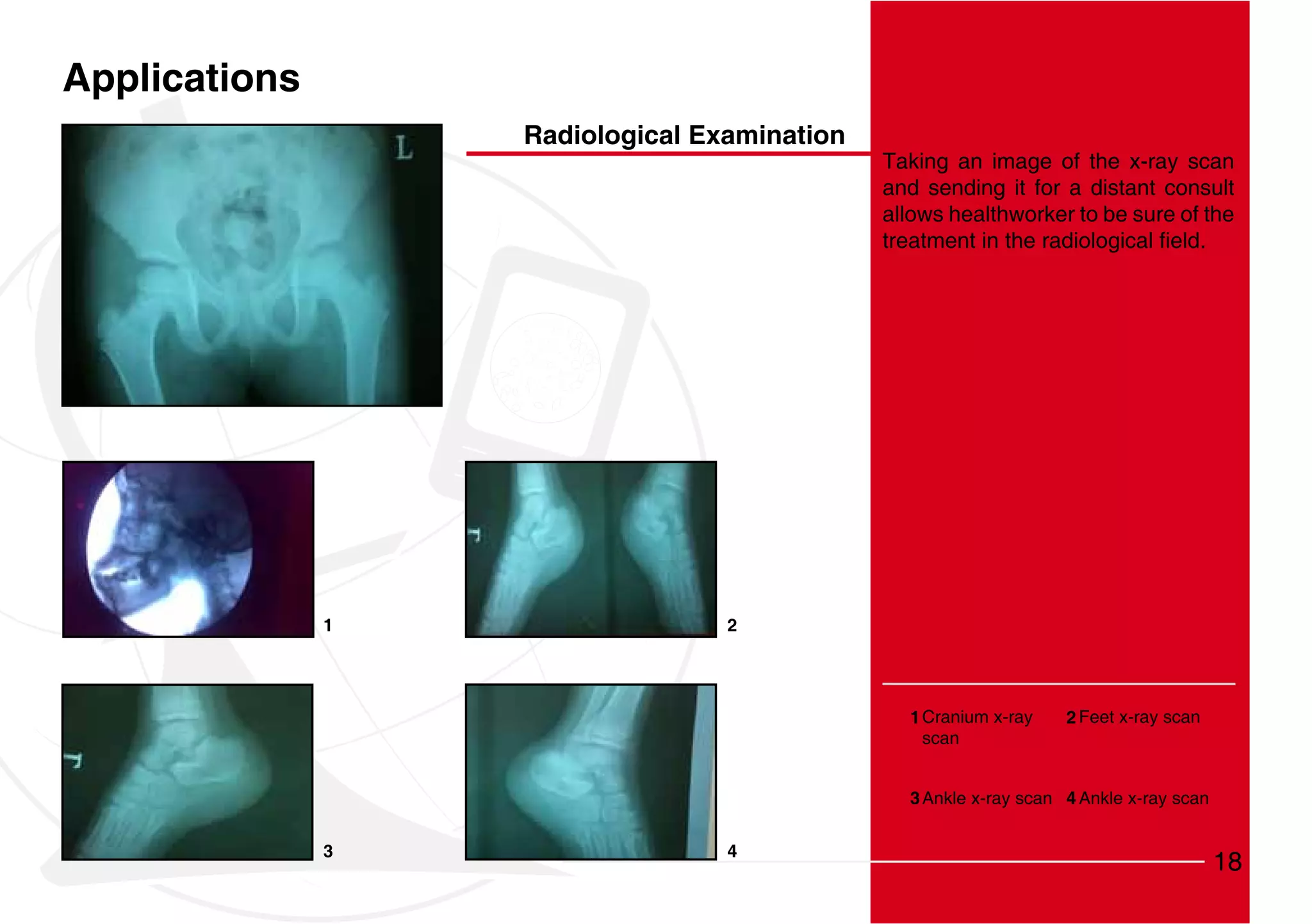 Applications
                   Radiological Examination
                                              Taking an image of the x-ray scan
                                              and sending it for a distant consult
                                              allows healthworker to be sure of the




               1                  2




                                                1 Cranium x-ray    2 Feet x-ray scan
                                                  scan


                                                3 Ankle x-ray scan 4 Ankle x-ray scan


               3                  4
                                                                                        18
 
