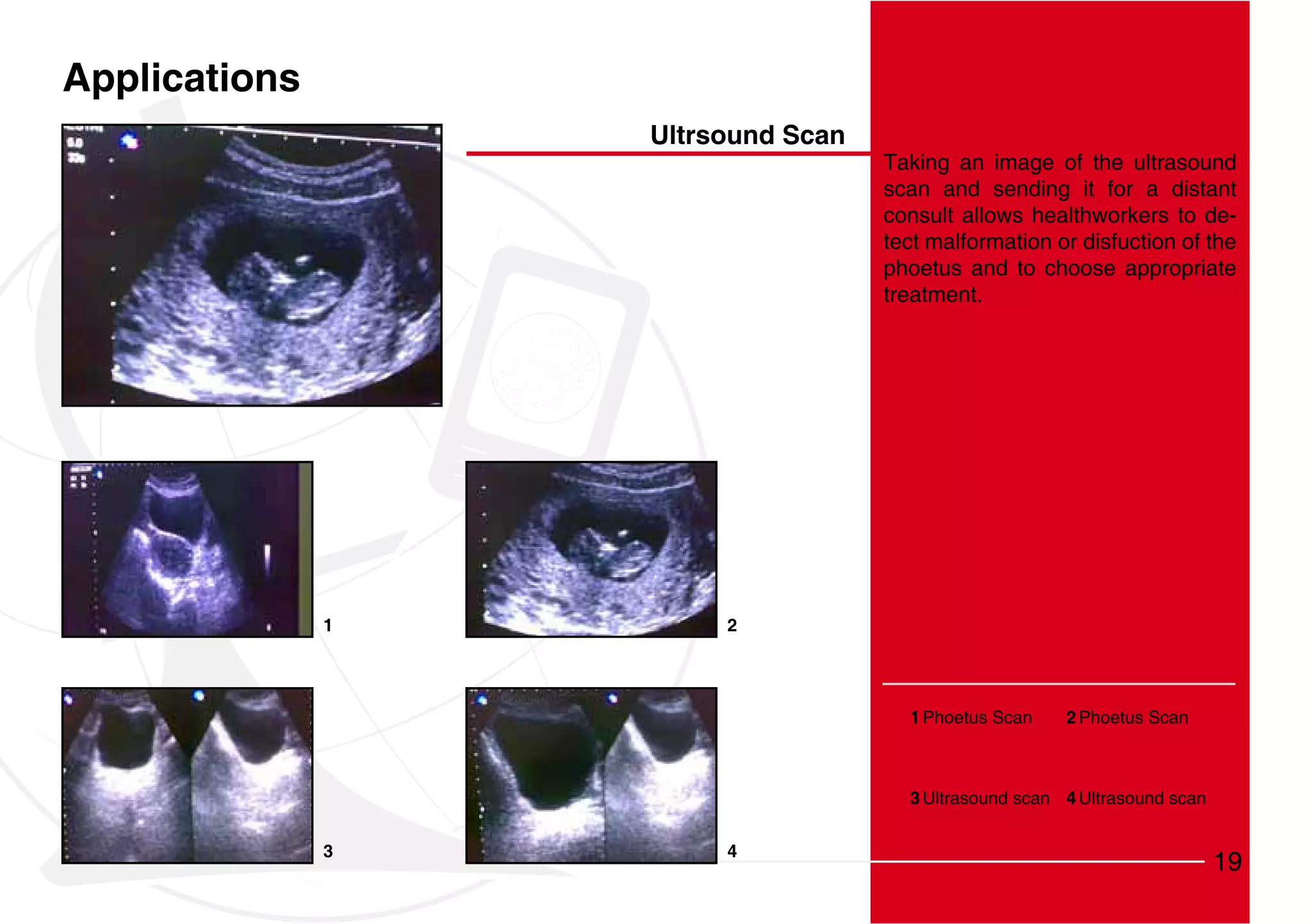 Applications
                   Ultrsound Scan
                                    Taking an image of the ultrasound
                                    scan and sending it for a distant
                                    consult allows healthworkers to de-
                                    tect malformation or disfuction of the
                                    phoetus and to choose appropriate
                                    treatment.




               1        2




                                      1 Phoetus Scan    2 Phoetus Scan



                                      3 Ultrasound scan 4 Ultrasound scan


               3        4
                                                                            19
 