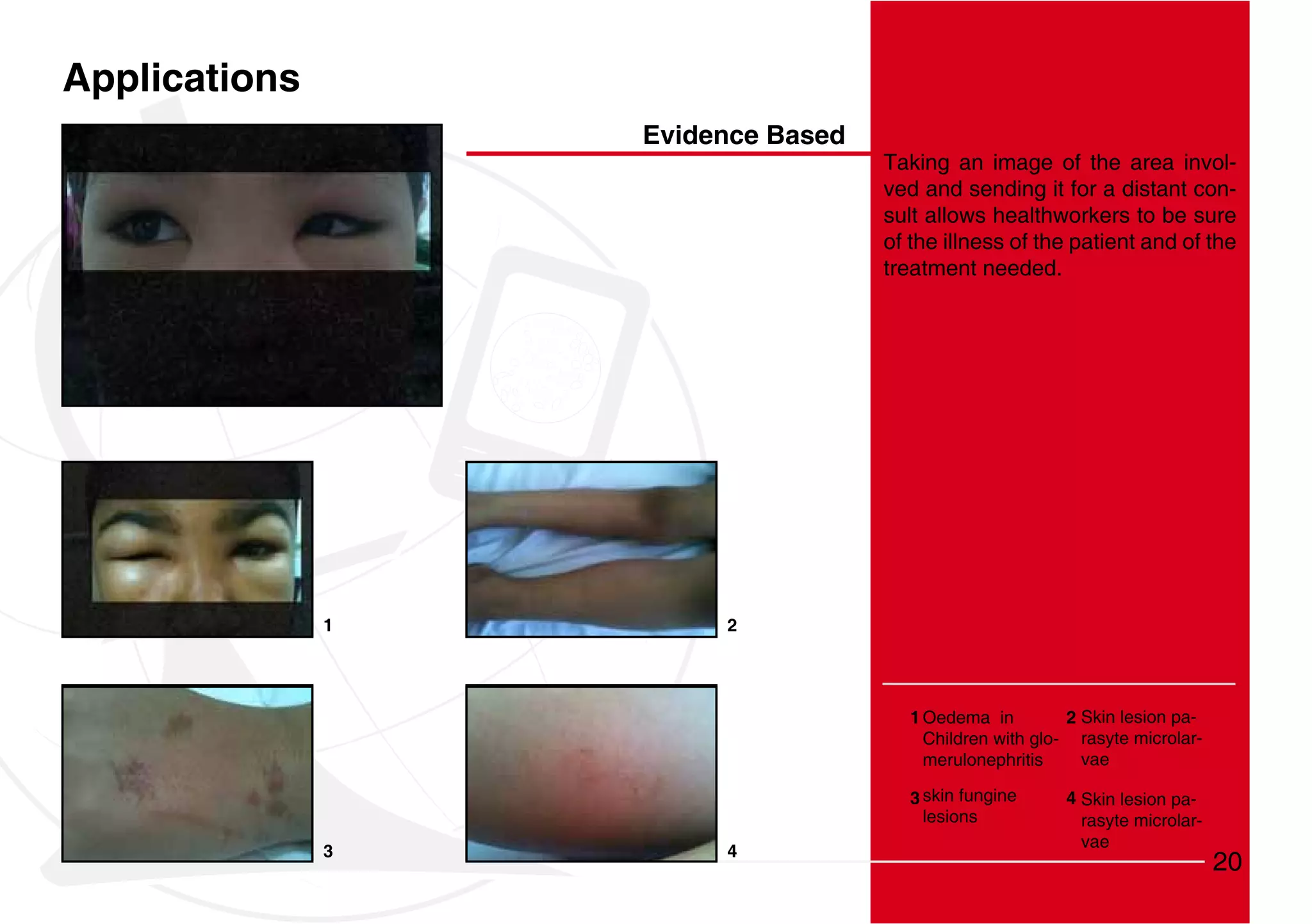 Applications
                   Evidence Based
                                    Taking an image of the area invol-
                                    ved and sending it for a distant con-
                                    sult allows healthworkers to be sure
                                    of the illness of the patient and of the
                                    treatment needed.




               1        2




                                       1 Oedema in         2 Skin lesion pa-
                                         Children with glo- rasyte microlar-
                                         merulonephritis     vae

                                       3 skin fungine     4 Skin lesion pa-
                                         lesions            rasyte microlar-
                                                            vae
               3        4
                                                                               20
 