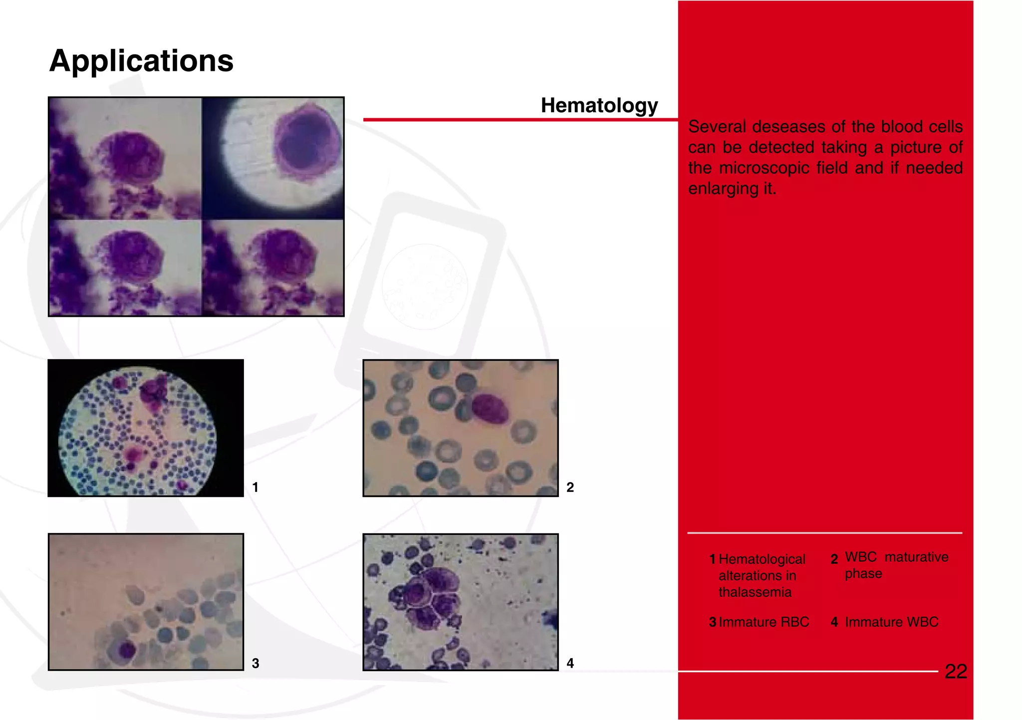 Applications
                   Hematology
                                Several deseases of the blood cells
                                can be detected taking a picture of

                                enlarging it.




               1     2




                                   1 Hematological    2 WBC maturative
                                     alterations in     phase
                                     thalassemia

                                   3 Immature RBC     4 Immature WBC


               3     4
                                                                       22
 