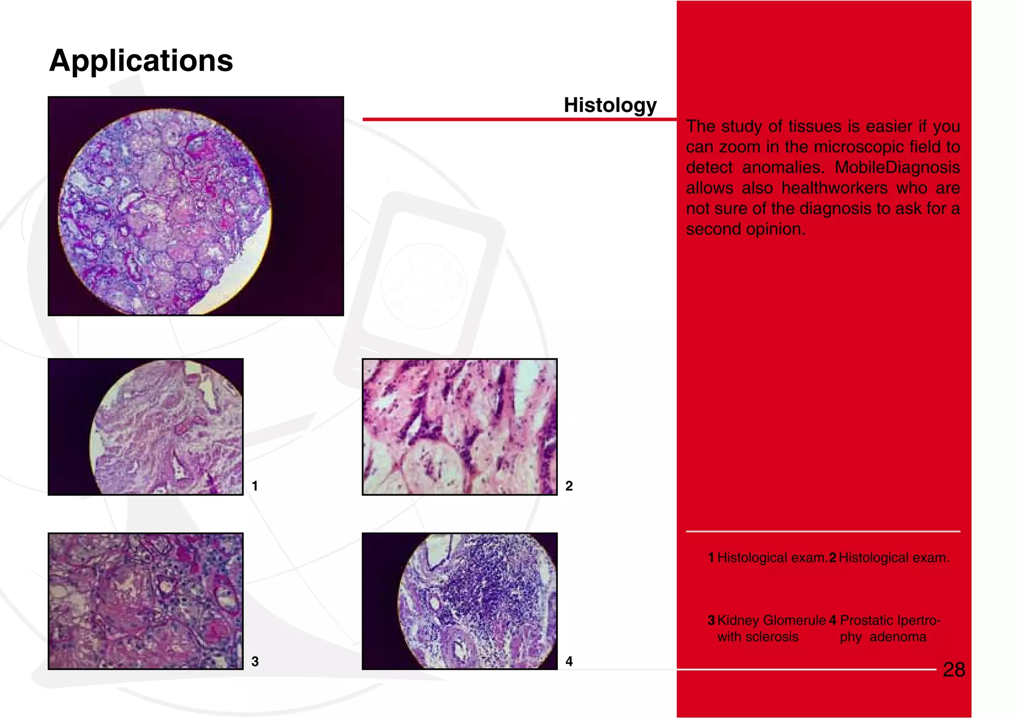 Applications
                   Histology
                               The study of tissues is easier if you

                               detect anomalies. MobileDiagnosis
                               allows also healthworkers who are
                               not sure of the diagnosis to ask for a
                               second opinion.




               1   2




                                 1 Histological exam. 2 Histological exam.



                                 3 Kidney Glomerule 4 Prostatic Ipertro-
                                   with sclerosis     phy adenoma
               3   4
                                                                           28
 
