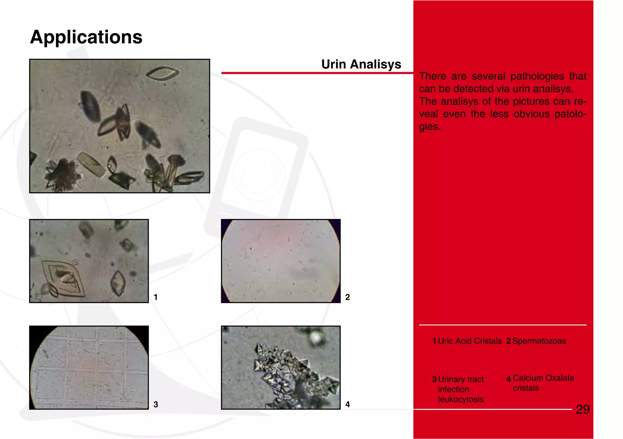 Applications
                   Urin Analisys
                                   There are several pathologies that
                                   can be detected via urin analisys.
                                   The analisys of the pictures can re-
                                   veal even the less obvious patolo-
                                   gies.




               1      2




                                     1 Uric Acid Cristals 2 Spermatozoas



                                     3 Urinary tract    4 Calcium Oxalate
                                       infection          cristals
                                       leukocytosis
               3      4
                                                                            29
 