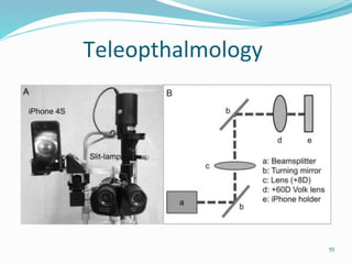 Teleopthalmology
55
 