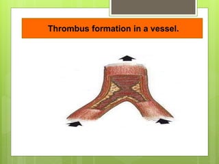 Thrombus formation in a vessel.
 