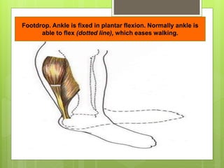 Footdrop. Ankle is fixed in plantar flexion. Normally ankle is
able to flex (dotted line), which eases walking.
 