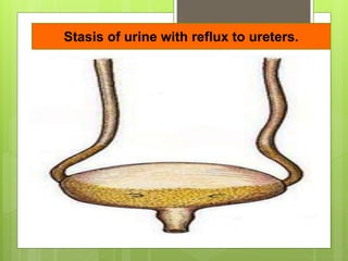 Stasis of urine with reflux to ureters.
 
