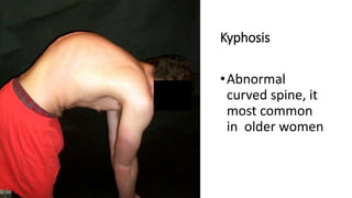 Kyphosis
•Abnormal
curved spine, it
most common
in older women
 