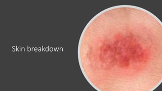 Skin breakdown
 
