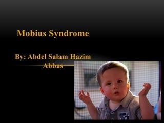 Mobius Syndrome
By: Abdel Salam Hazim
Abbas
5/03/2018 1
 