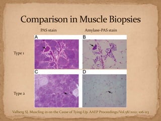 PAS stain

Amylase-PAS stain

Type 1

Type 2

Valberg SJ. Muscling in on the Cause of Tying-Up. AAEP Proceedings/Vol.58/2012; 106-113

 