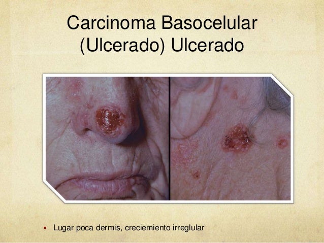El régimen al tratamiento de la eccema