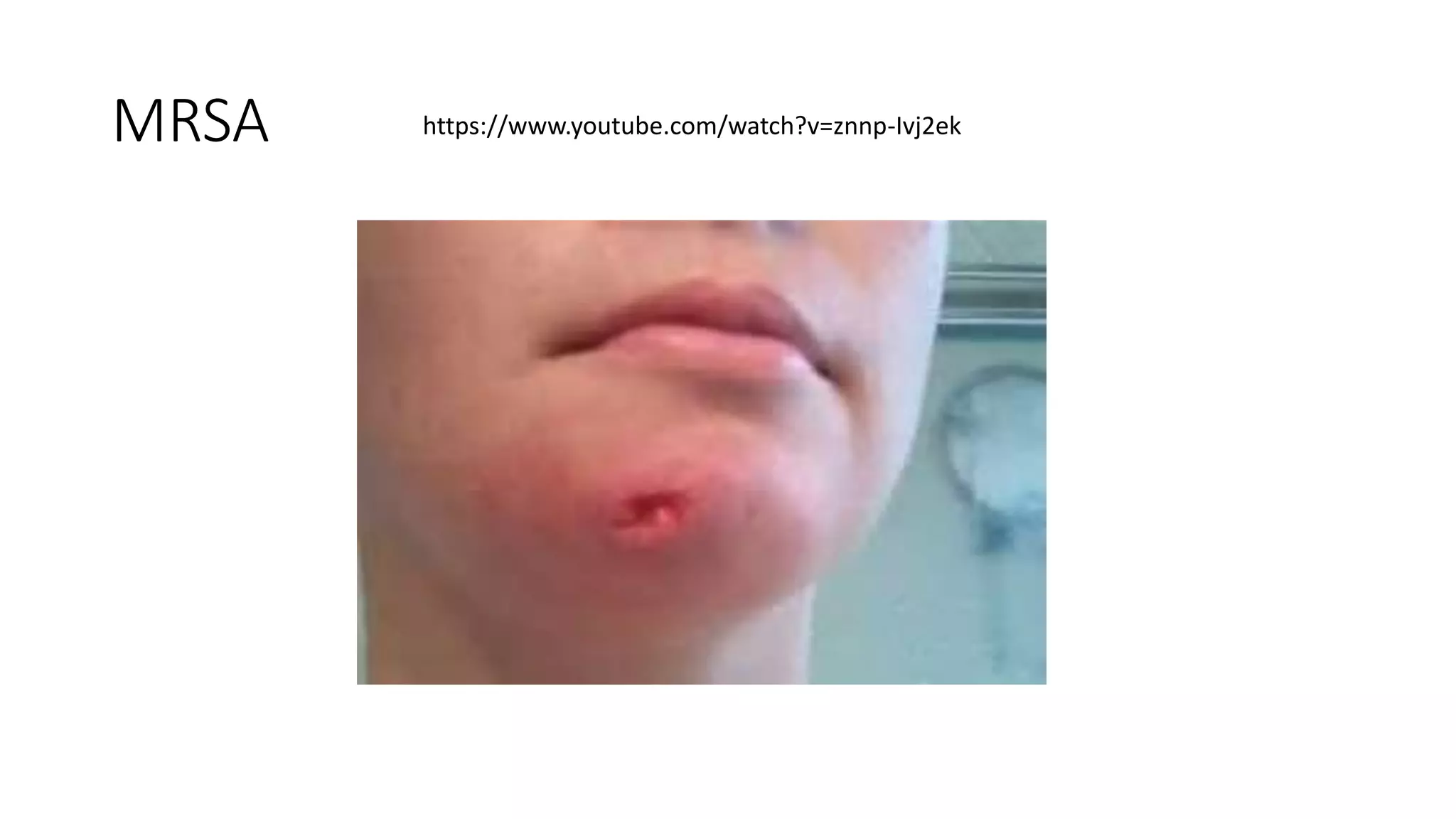 MRSA https://www.youtube.com/watch?v=znnp-Ivj2ek
 