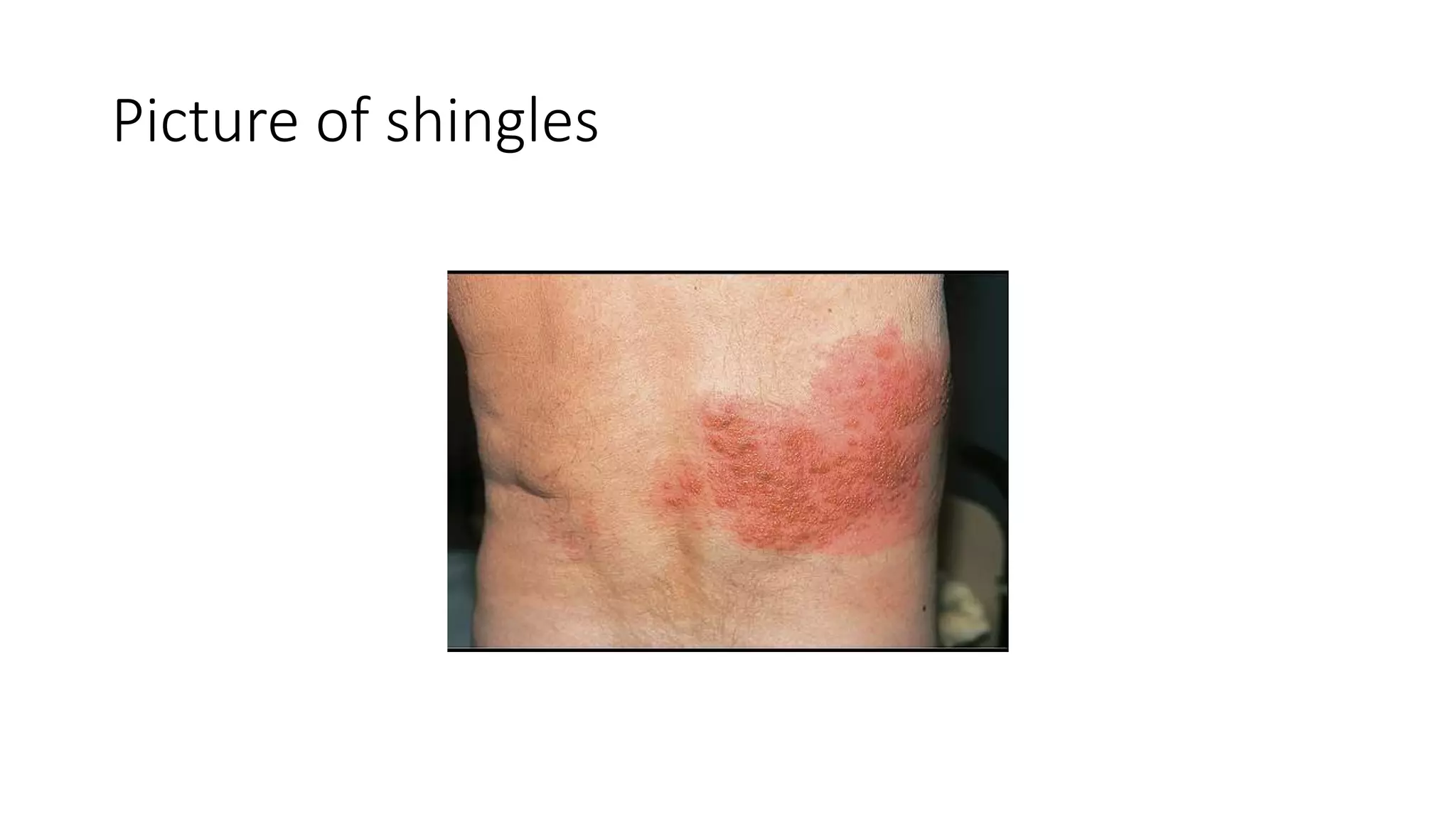 Picture of shingles
 