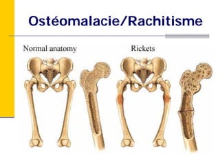 Ostéomalacie/Rachitisme
 