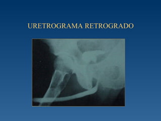 URETROGRAMA RETROGRADO 