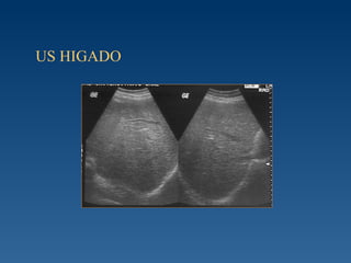 US HIGADO  
