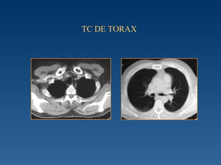 TC DE TORAX 