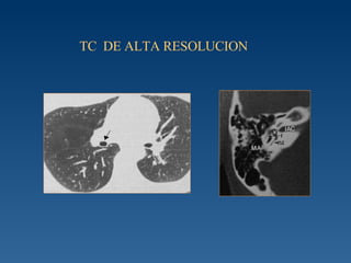 TC  DE ALTA RESOLUCION  