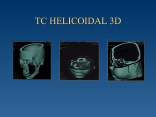 TC HELICOIDAL 3D 