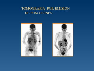 TOMOGRAFIA  POR EMISION DE POSITRONES 