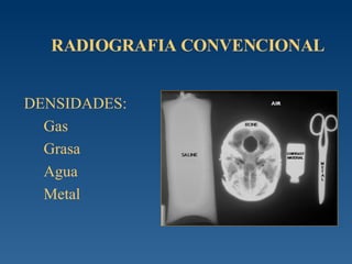 RADIOGRAFIA CONVENCIONAL DENSIDADES: Gas Grasa Agua Metal 