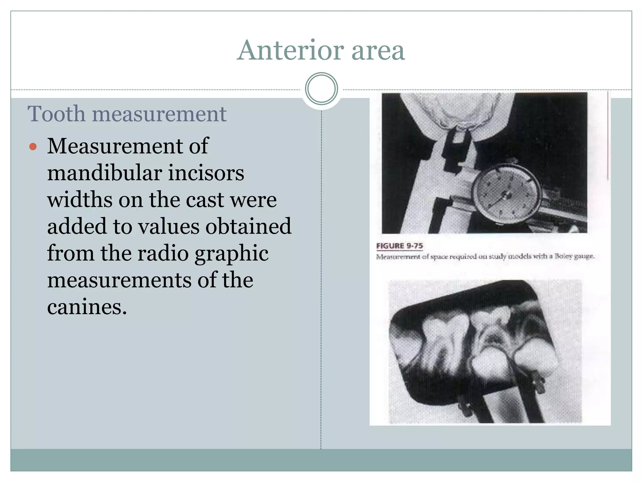 Anterior area
Tooth measurement
 Measurement of
mandibular incisors
widths on the cast were
added to values obtained
from the radio graphic
measurements of the
canines.
 
